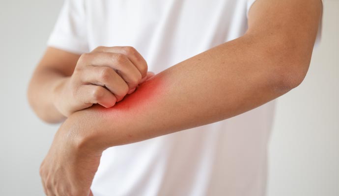 A person scratching his hand due to allergic reaction A person scratching his hand due to allergic reaction